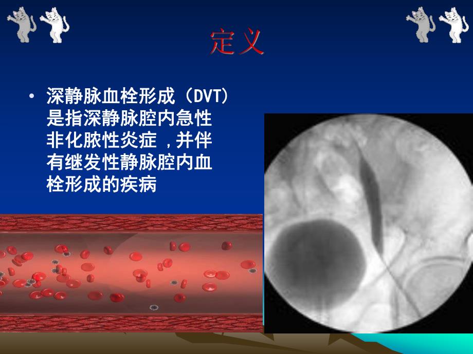 深静脉血栓的治疗和护理.ppt_第2页