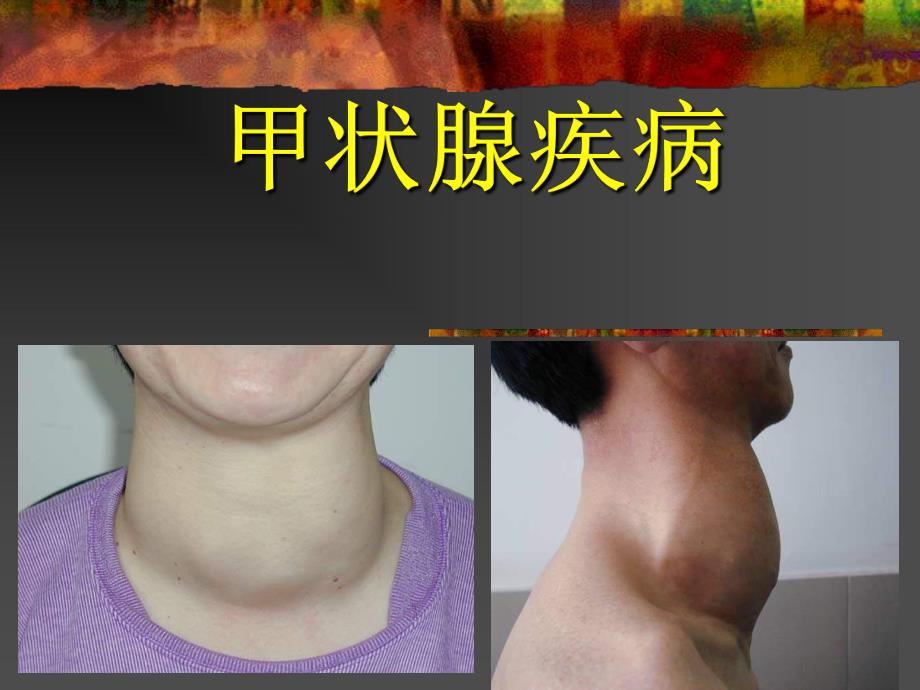 甲状腺病.ppt.ppt_第1页