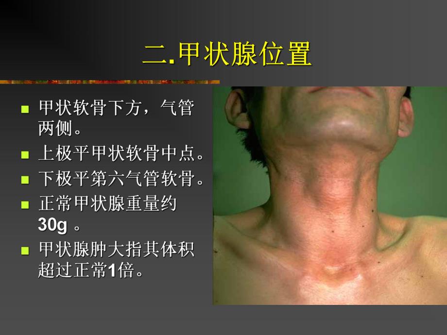 甲状腺病.ppt.ppt_第3页