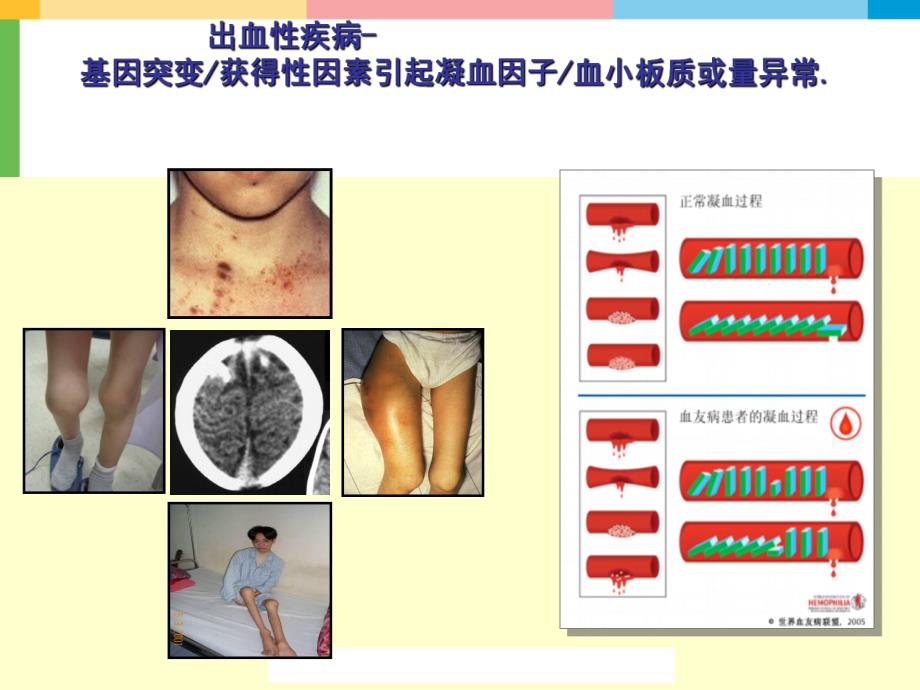 [精品]出血性疾病的诊断思路.ppt_第3页