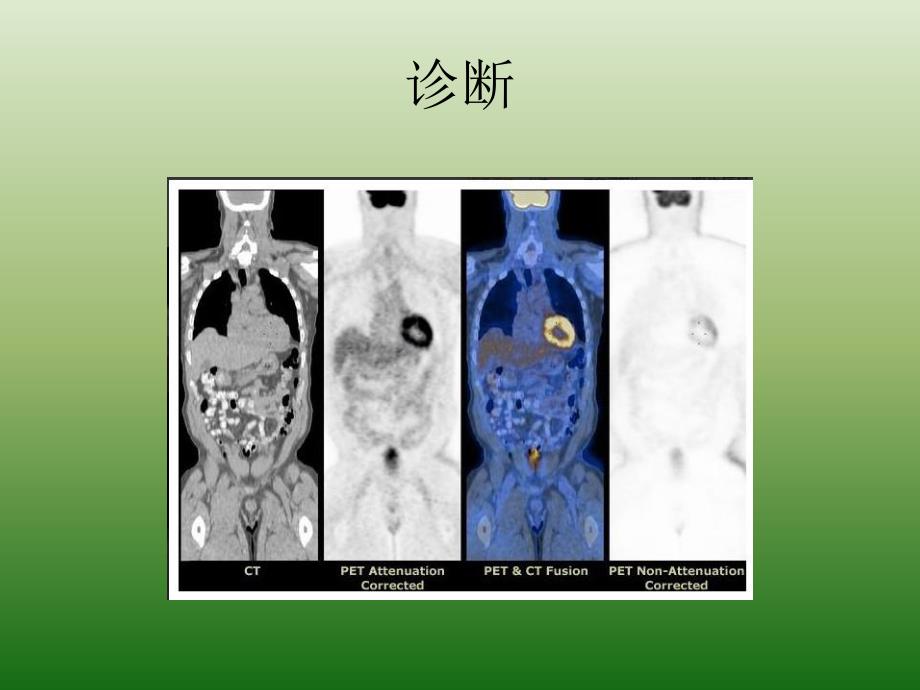 肺癌诊断及综合治疗.ppt_第3页