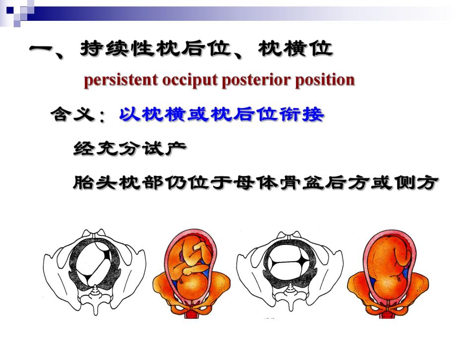 胎位异常教案PPT.ppt_第3页