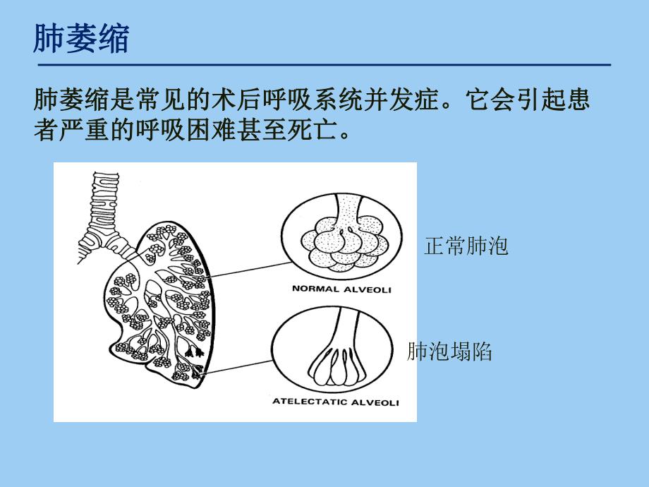 肺萎缩与深呼吸训练器.ppt_第2页