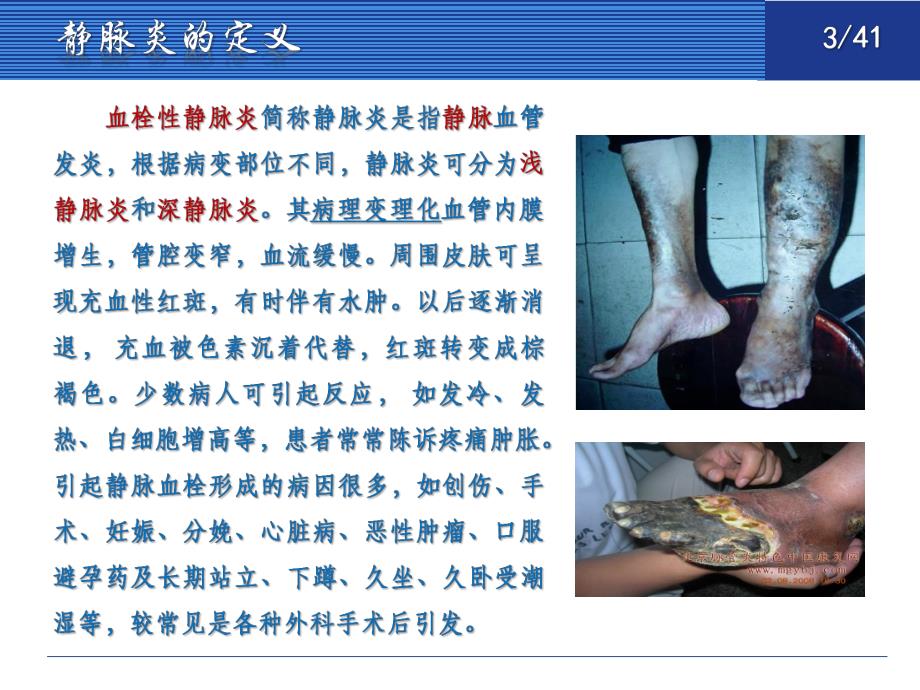 静脉炎的临床表现及护理.ppt_第3页