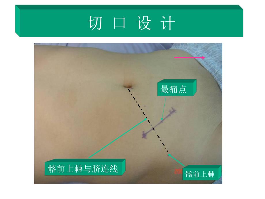 阑尾切除术.ppt_第2页