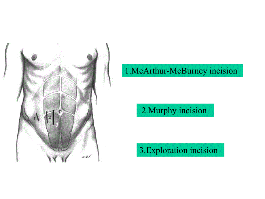 阑尾切除术.ppt_第3页