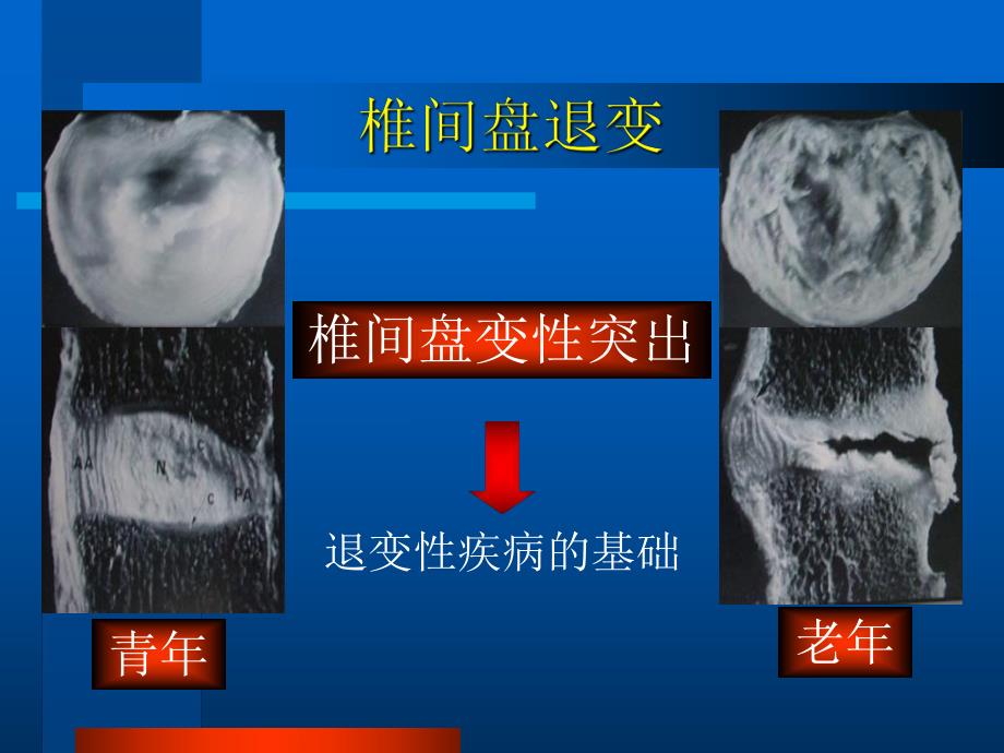 腰椎间盘突出症医学演示文稿.ppt_第2页