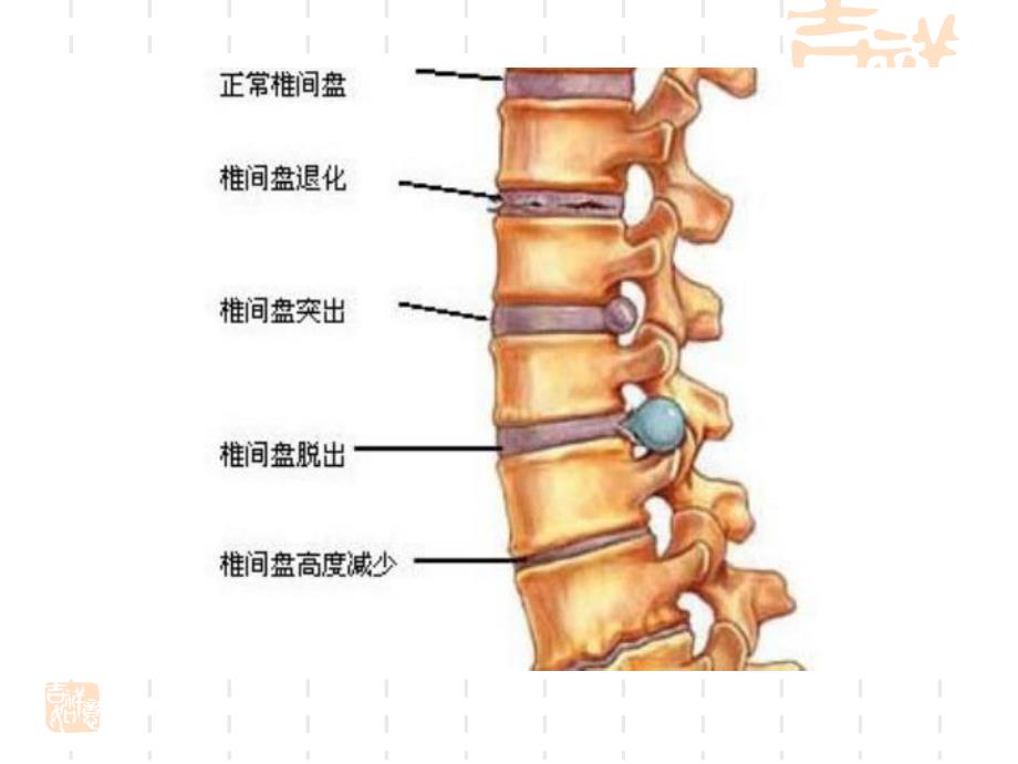 腰椎间盘突出症治疗方案.ppt_第3页