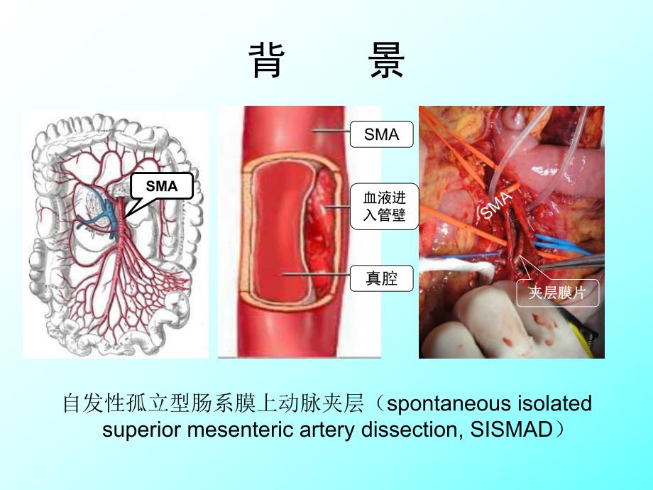 自发性孤立型肠系膜上动脉夹层影像学特征在治疗策略中的价值.ppt_第2页