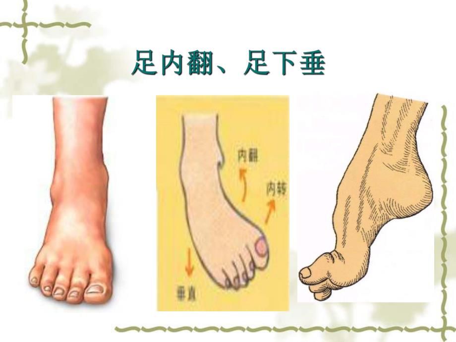 脑卒中后足内翻、下垂.ppt_第2页