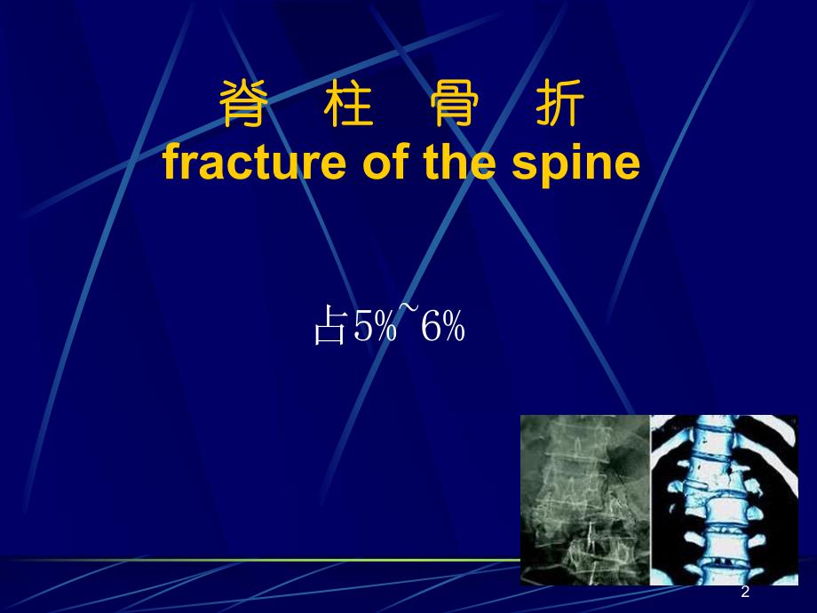 脊柱骨盆骨折.ppt_第2页