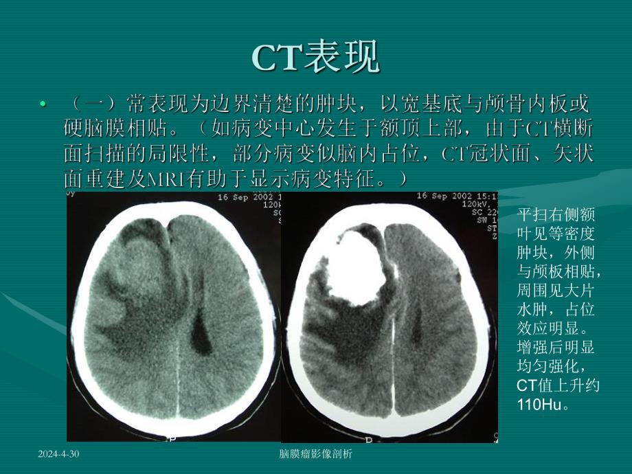 脑膜瘤CT、MRI表现.ppt_第3页