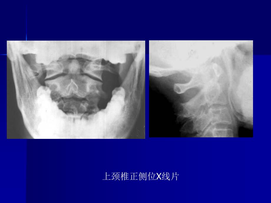 脊柱外科影像学检查.ppt_第3页