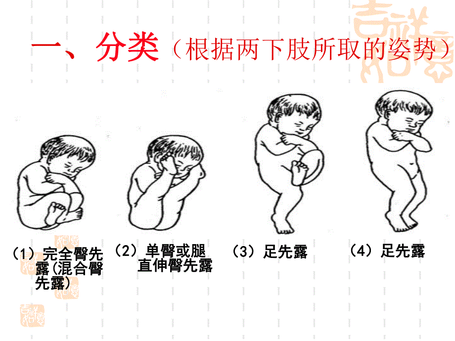 臀位分娩.ppt_第2页