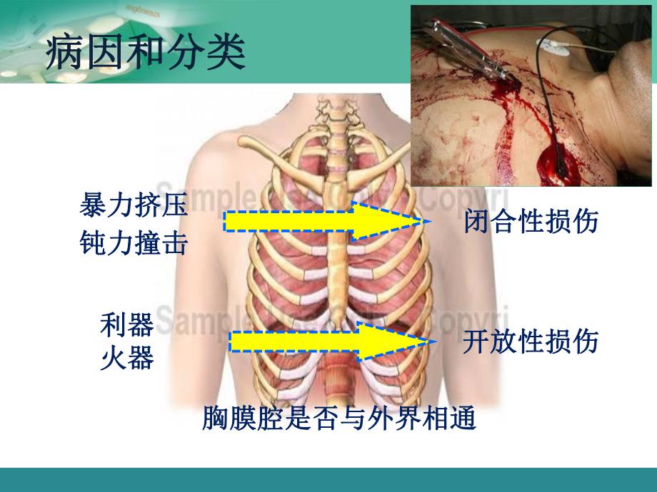 胸部疾病病人的护理.ppt_第3页