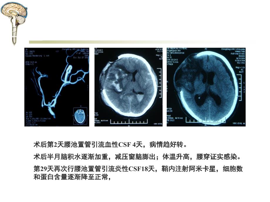 腰大池穿刺置管引流术.ppt_第3页