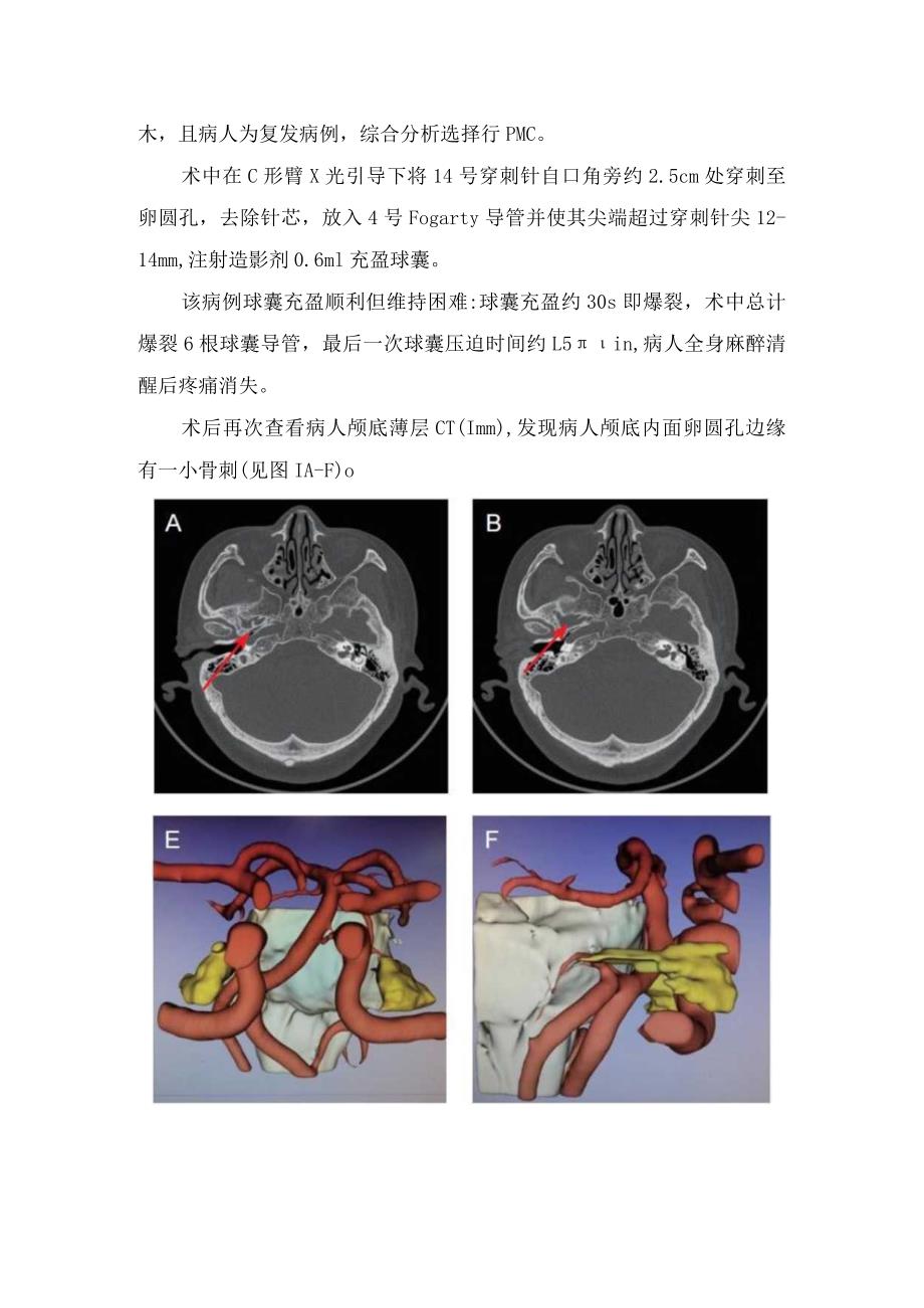 临床经皮微球囊压迫术中球囊反复爆裂病例及病例讨论.docx_第2页