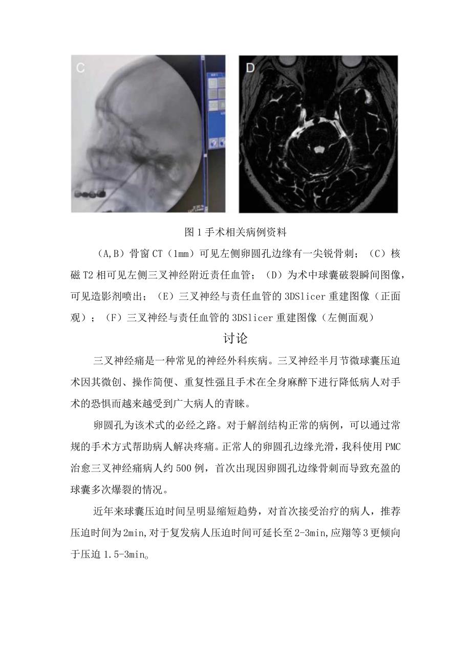 临床经皮微球囊压迫术中球囊反复爆裂病例及病例讨论.docx_第3页