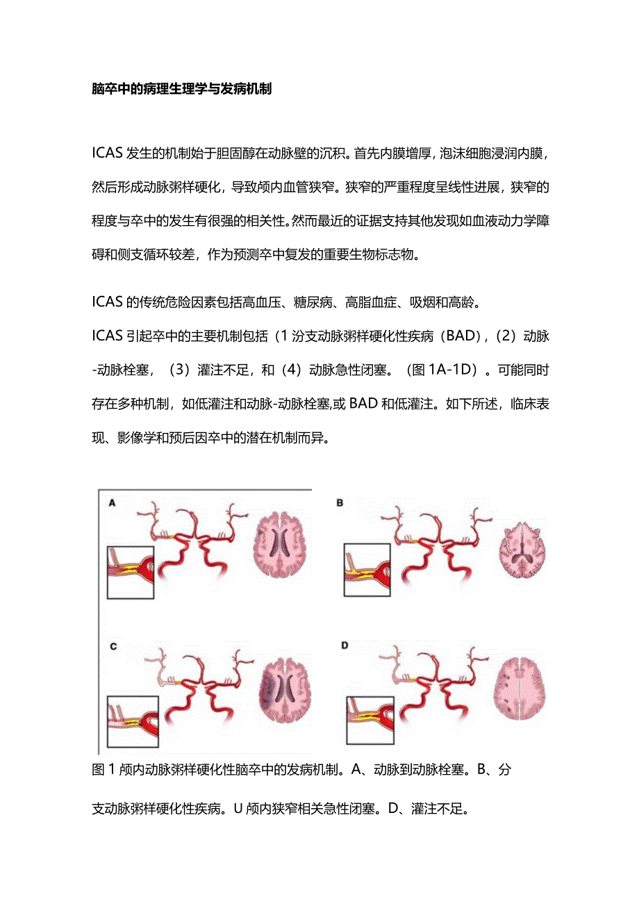 2024颅内动脉狭窄引起的急性大血管闭塞识别和管理.docx_第2页