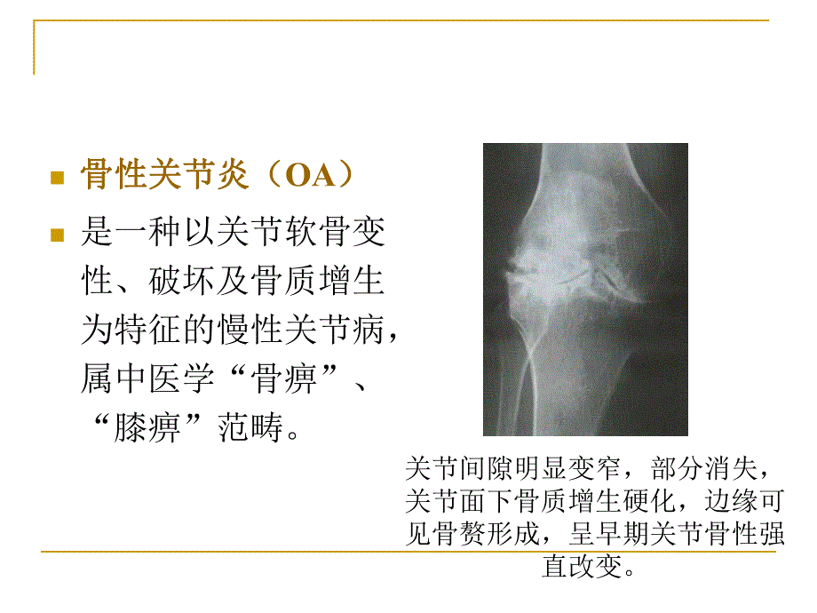 骨关节痹症(骨性关节炎).ppt.ppt_第1页