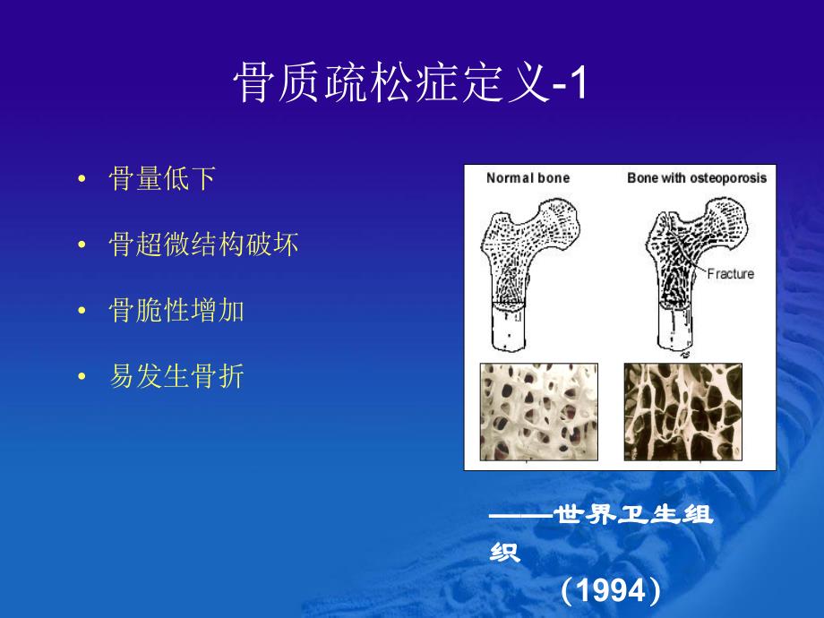 骨质疏松症的诊断与治.ppt_第3页