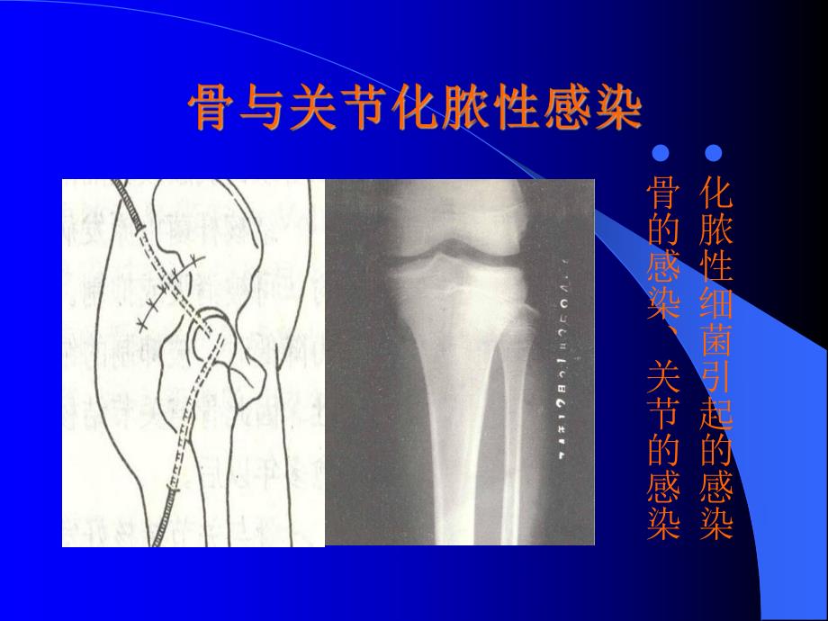 骨与关节感染.ppt_第2页