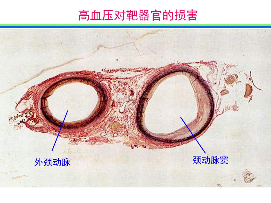 高血压对靶器官的损害.ppt_第1页