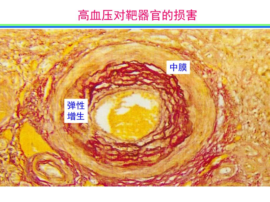 高血压对靶器官的损害.ppt_第3页