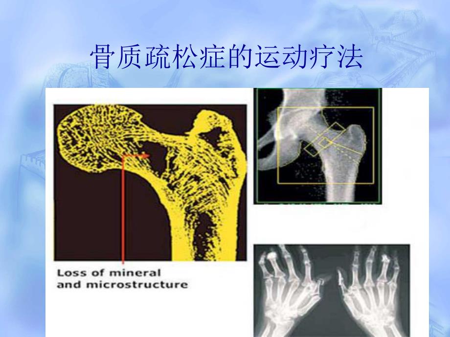 骨质疏松症的运动疗法.ppt_第1页