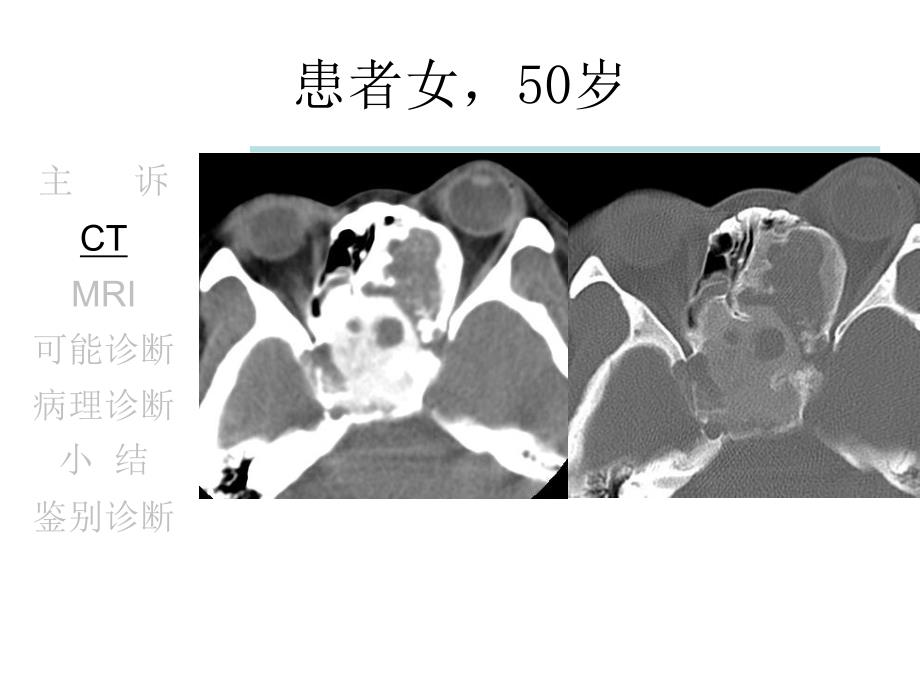 骨化性纤维瘤.ppt_第3页