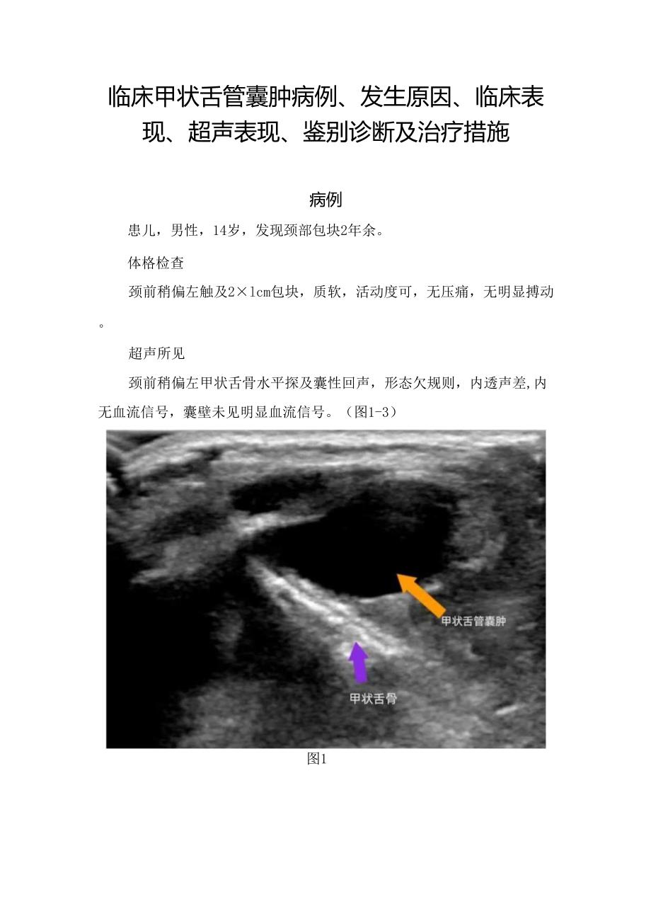 临床甲状舌管囊肿病例、发生原因、临床表现、超声表现、鉴别诊断及治疗措施.docx_第1页