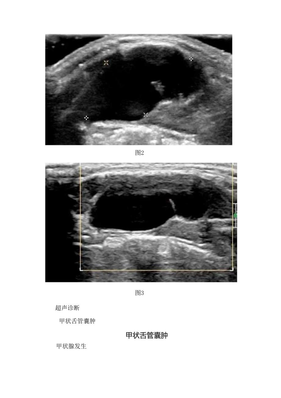 临床甲状舌管囊肿病例、发生原因、临床表现、超声表现、鉴别诊断及治疗措施.docx_第2页