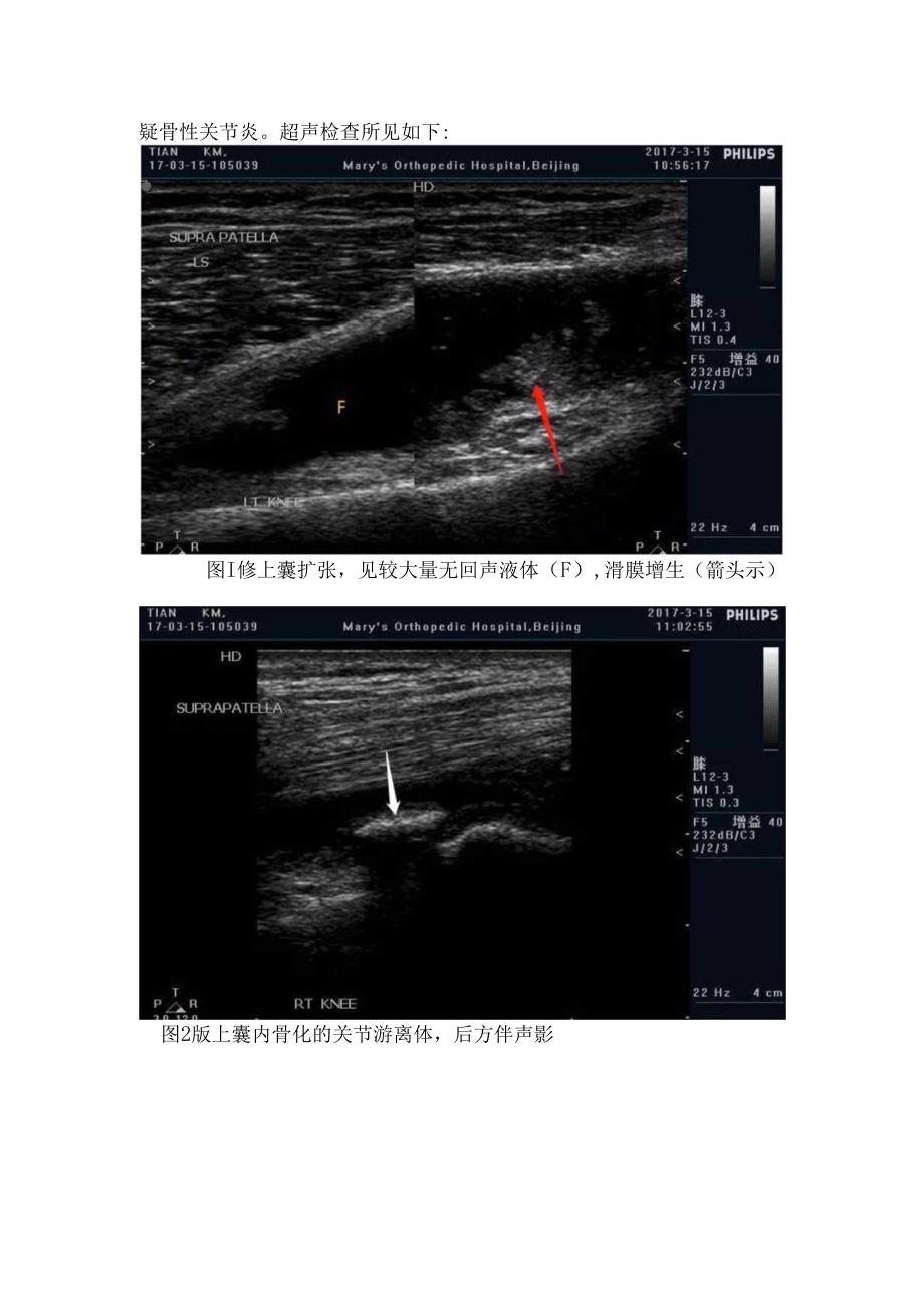 临床膝关节骨性关节炎病理、超声检查、病例分享及注意鉴别要点.docx_第2页