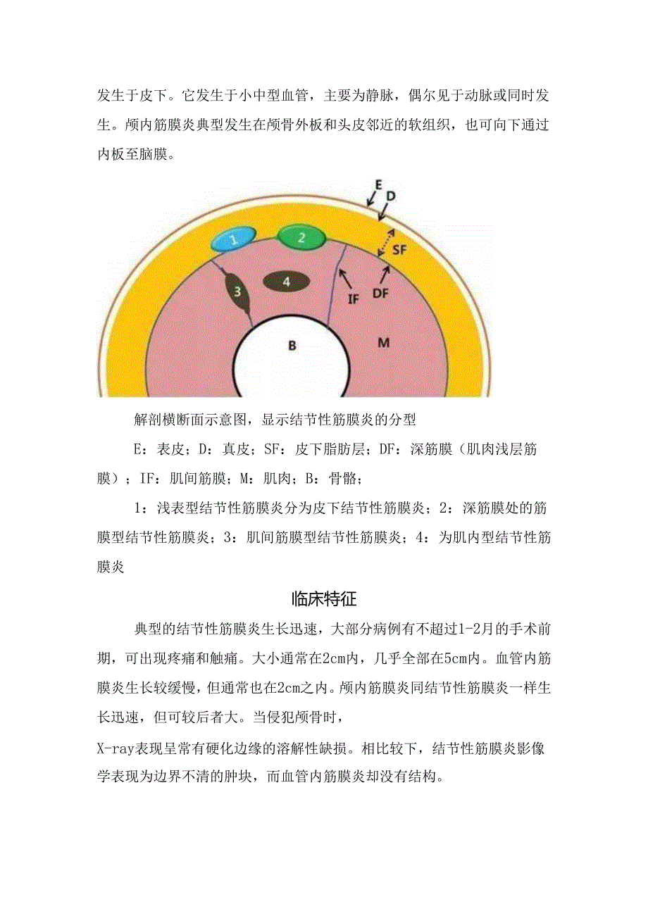 临床结节性筋膜炎临床表现、疾病分型、发病原因、发生部位、临床特征、病因学、影像学特征及鉴别诊断.docx_第2页