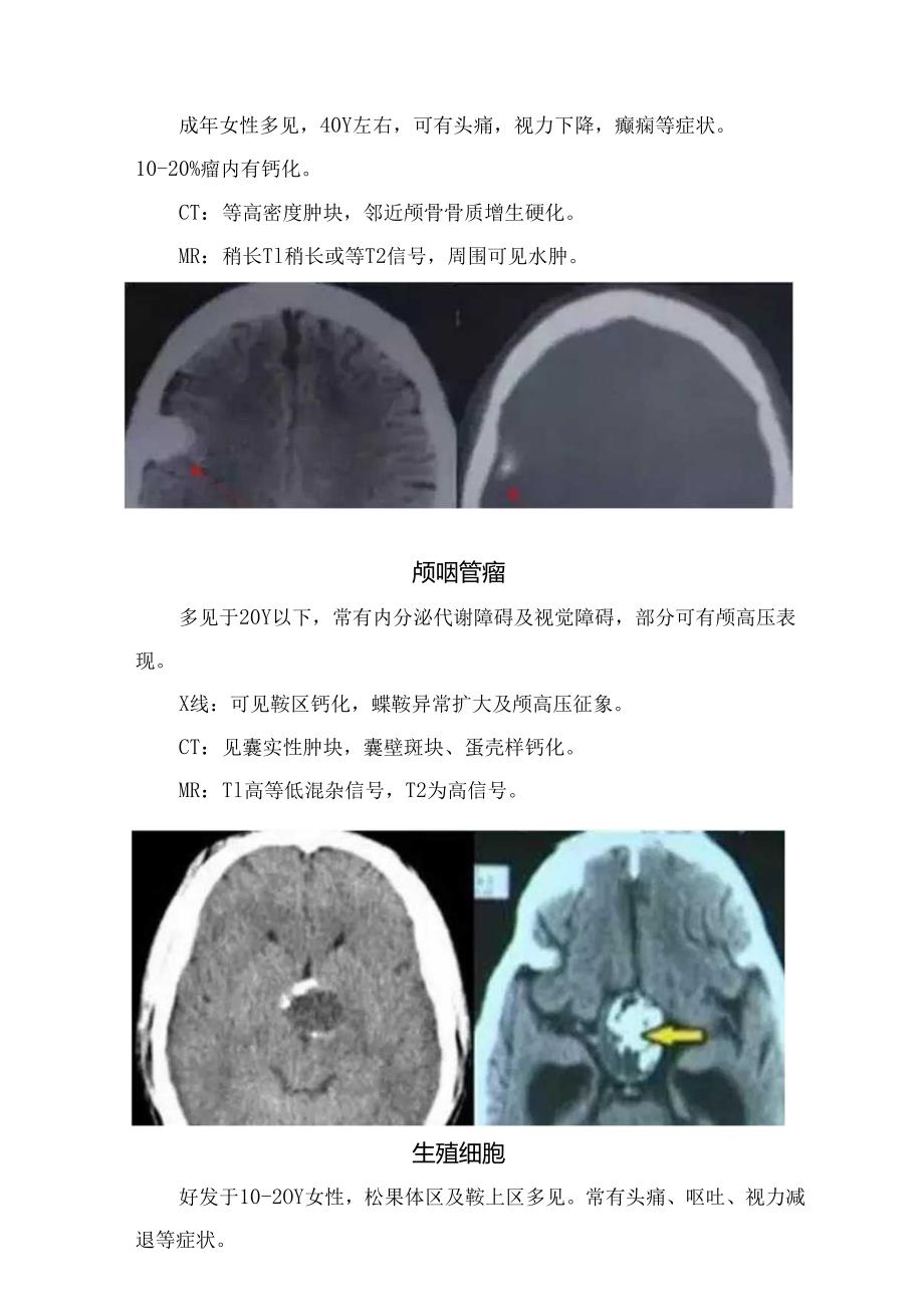 临床少突胶质细胞瘤、颅咽管瘤、生殖细胞、动静脉畸形、颅内动脉瘤等颅内钙化性病变影像学表现要点.docx_第2页