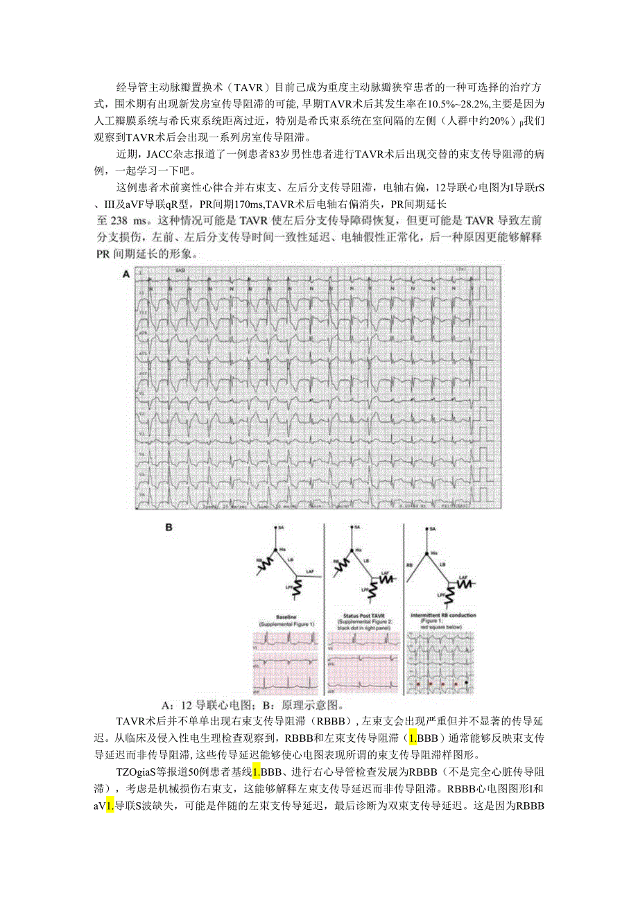 TAVR术后交替束支传导阻滞的隐藏意义.docx_第1页