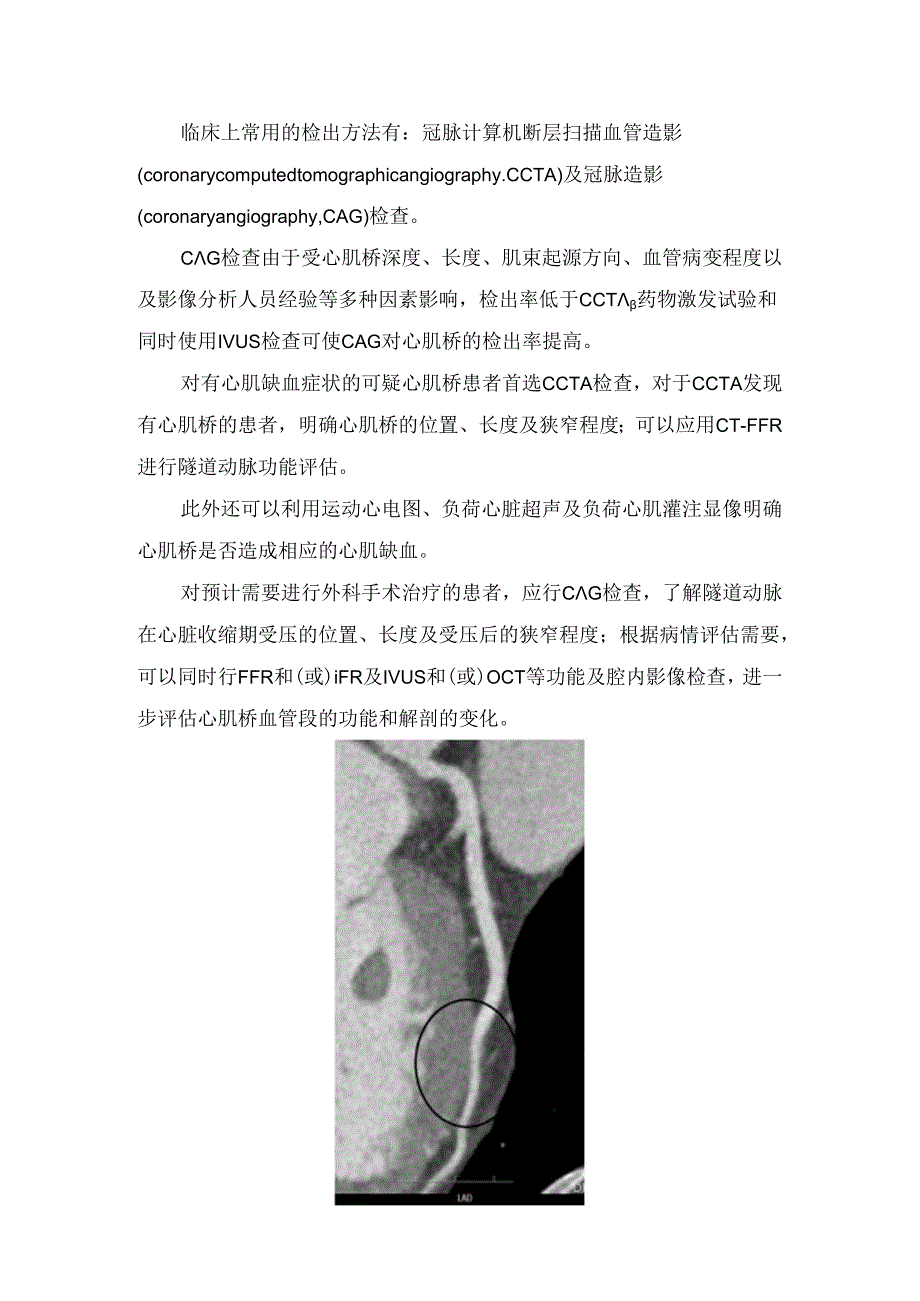 临床心肌桥疾病概念、临床症状、诊断及治疗要点.docx_第2页