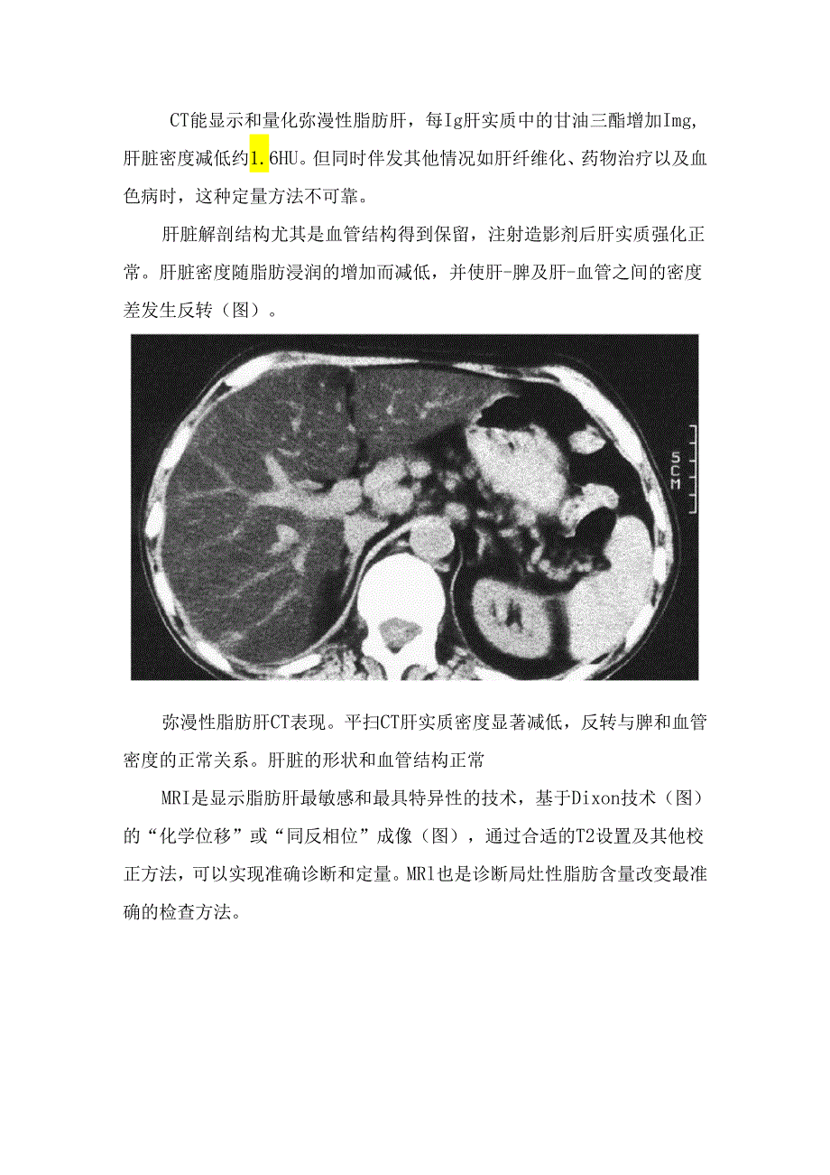 临床脂肪肝、肝豆状核变性(Wilson病、肝硬化、血色病及铁沉积等良性弥漫性肝脏病变表现临床表现及影像学特征 - 副本.docx_第2页