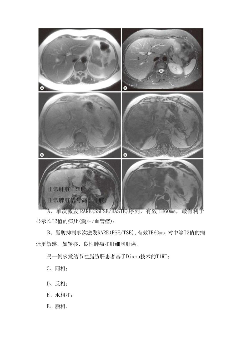 临床脂肪肝、肝豆状核变性(Wilson病、肝硬化、血色病及铁沉积等良性弥漫性肝脏病变表现临床表现及影像学特征 - 副本.docx_第3页