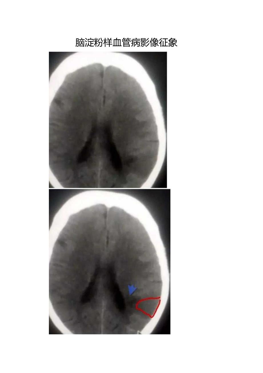 脑淀粉样血管病影像征象.docx_第1页