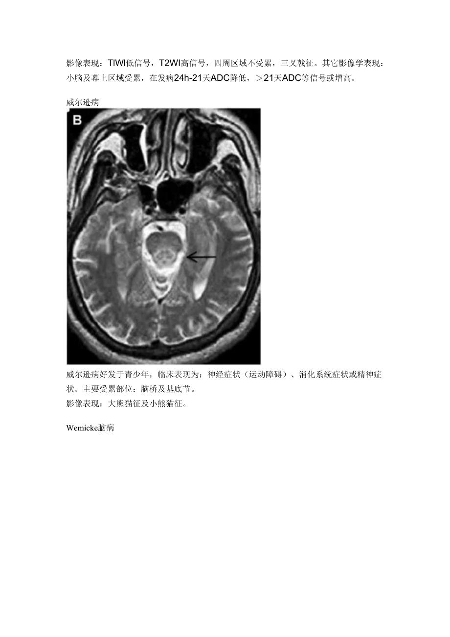 30张图理清脑干病变(代谢炎症篇).docx_第2页