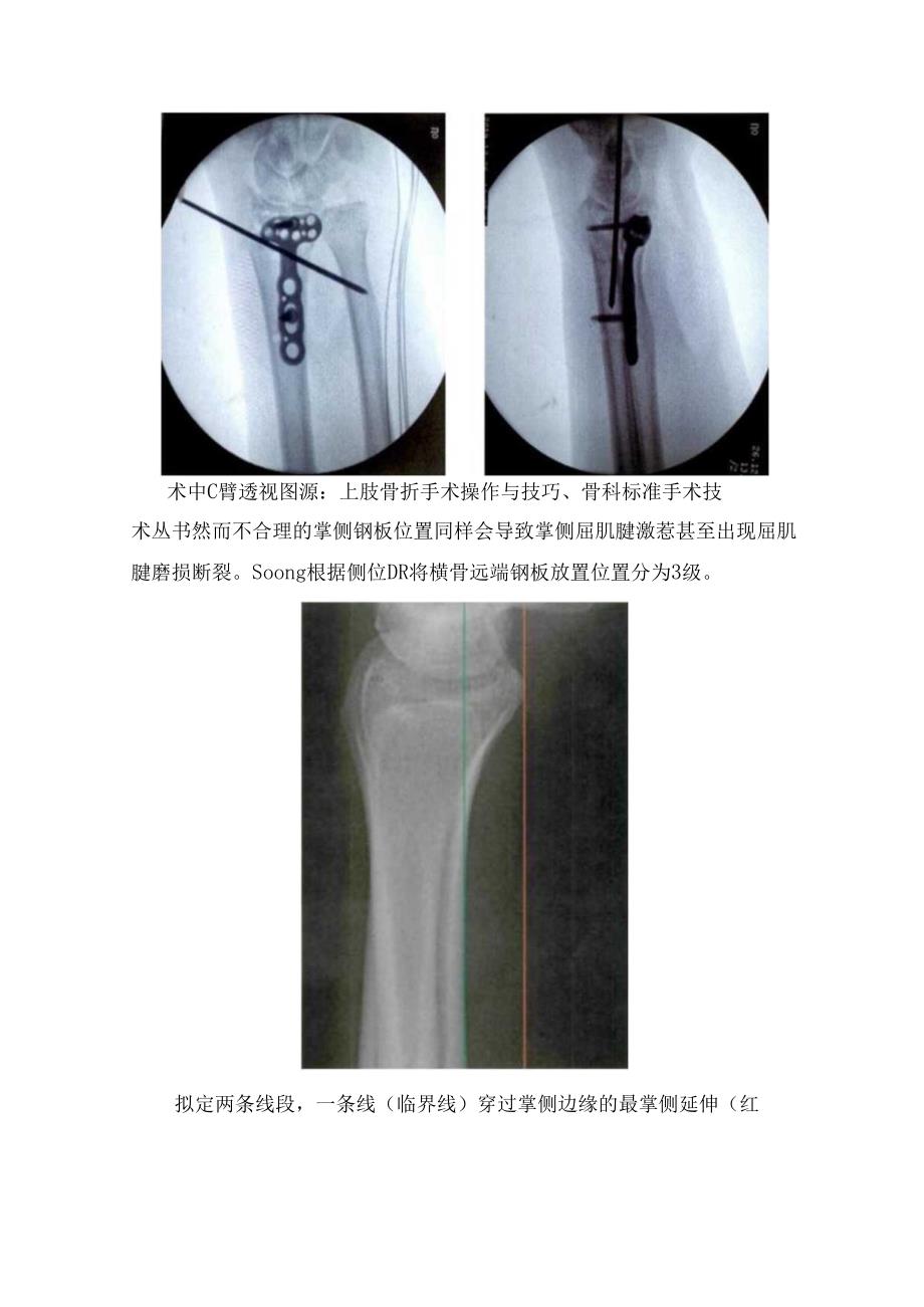 临床桡骨远端骨折掌侧入路要点.docx_第3页