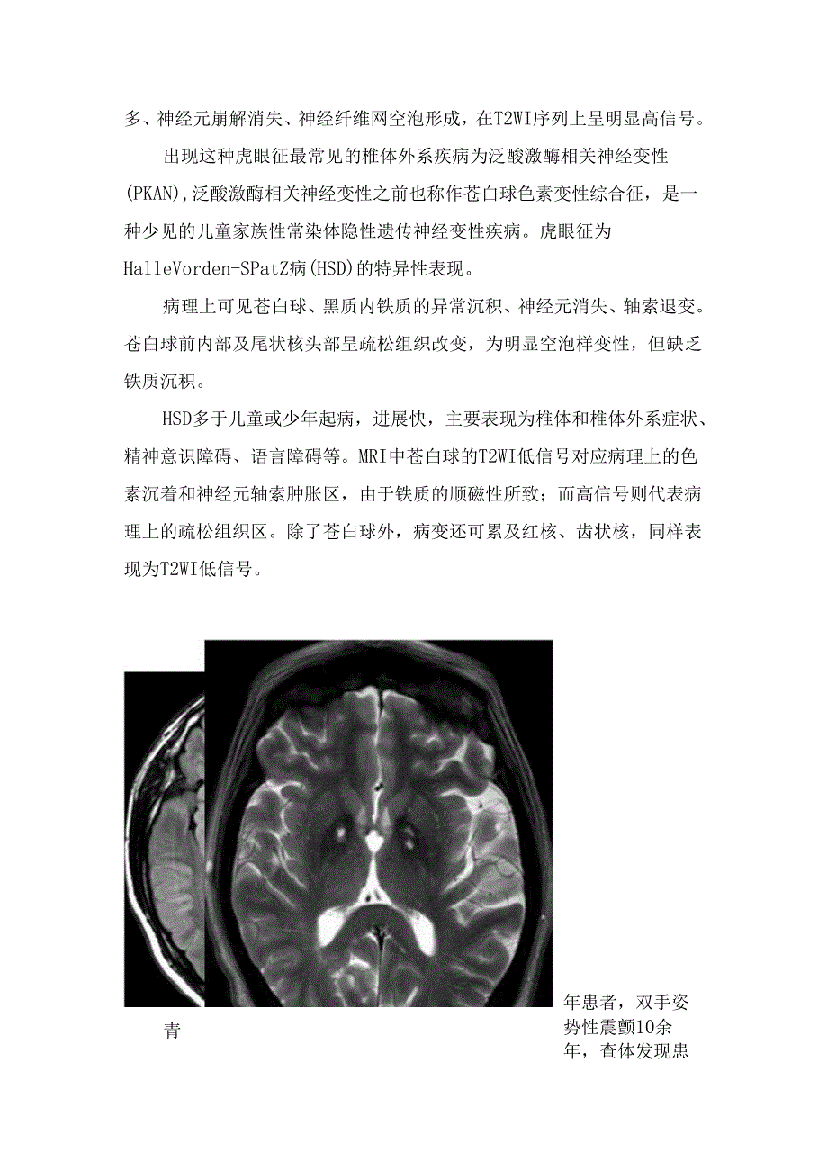 临床脑组织铁沉积性神经变性疾病虎眼征影像学征象、病理及疾病鉴别 - 副本.docx_第2页