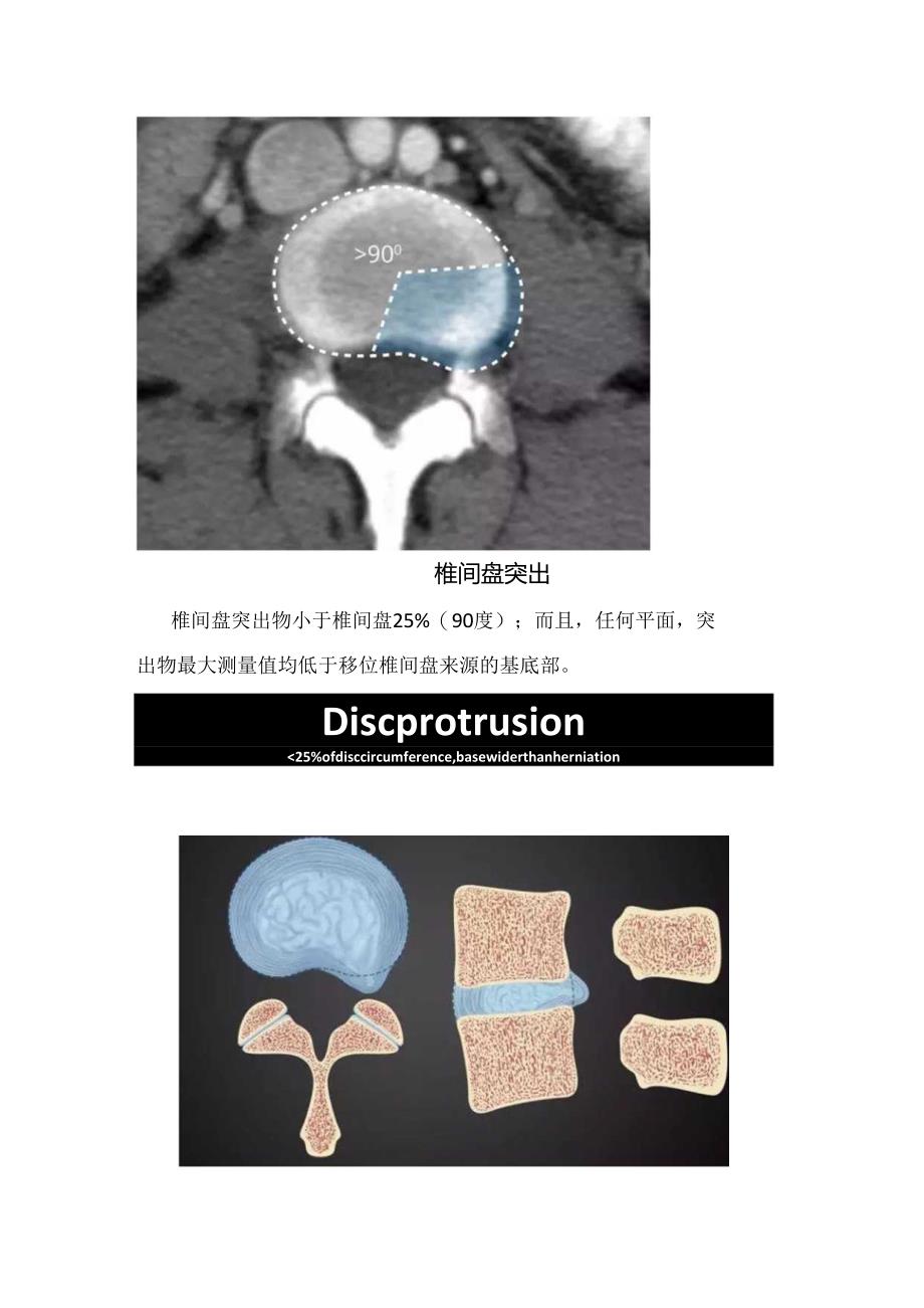 腰椎间盘正常表现、突出、膨出临床表现.docx_第2页