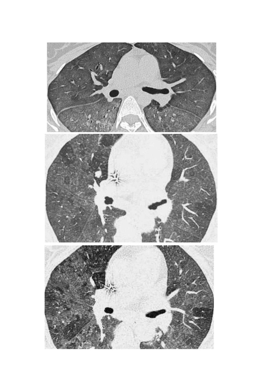 临床过敏性肺炎病理、临床表现、病因、诊断要点及影像表现.docx_第3页