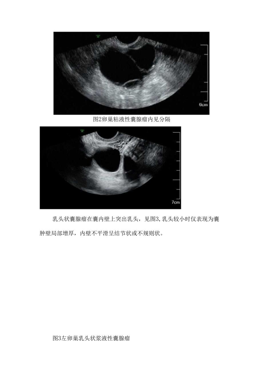 临床卵巢囊腺瘤高发人群、临床表现、病理、超声表现及注意事项.docx_第3页