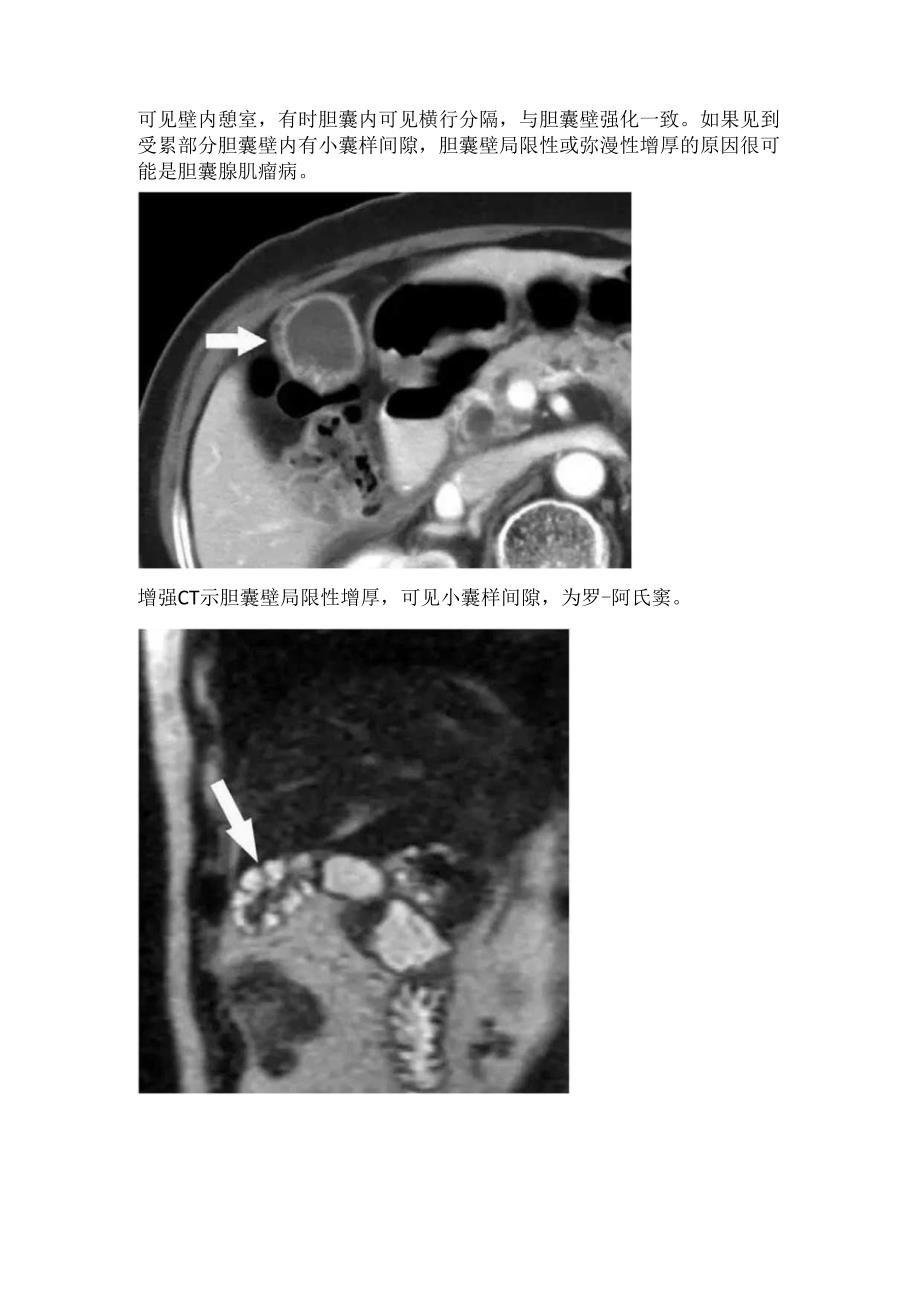 临床胆囊腺肌症病因病理、疾病分型、临床表现、影像学表现及鉴别诊断.docx_第2页