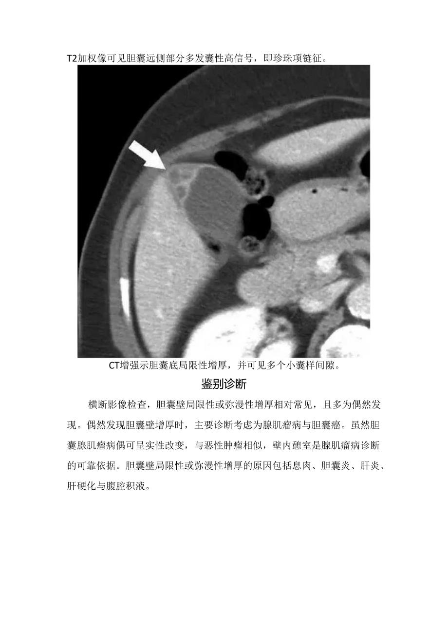 临床胆囊腺肌症病因病理、疾病分型、临床表现、影像学表现及鉴别诊断.docx_第3页