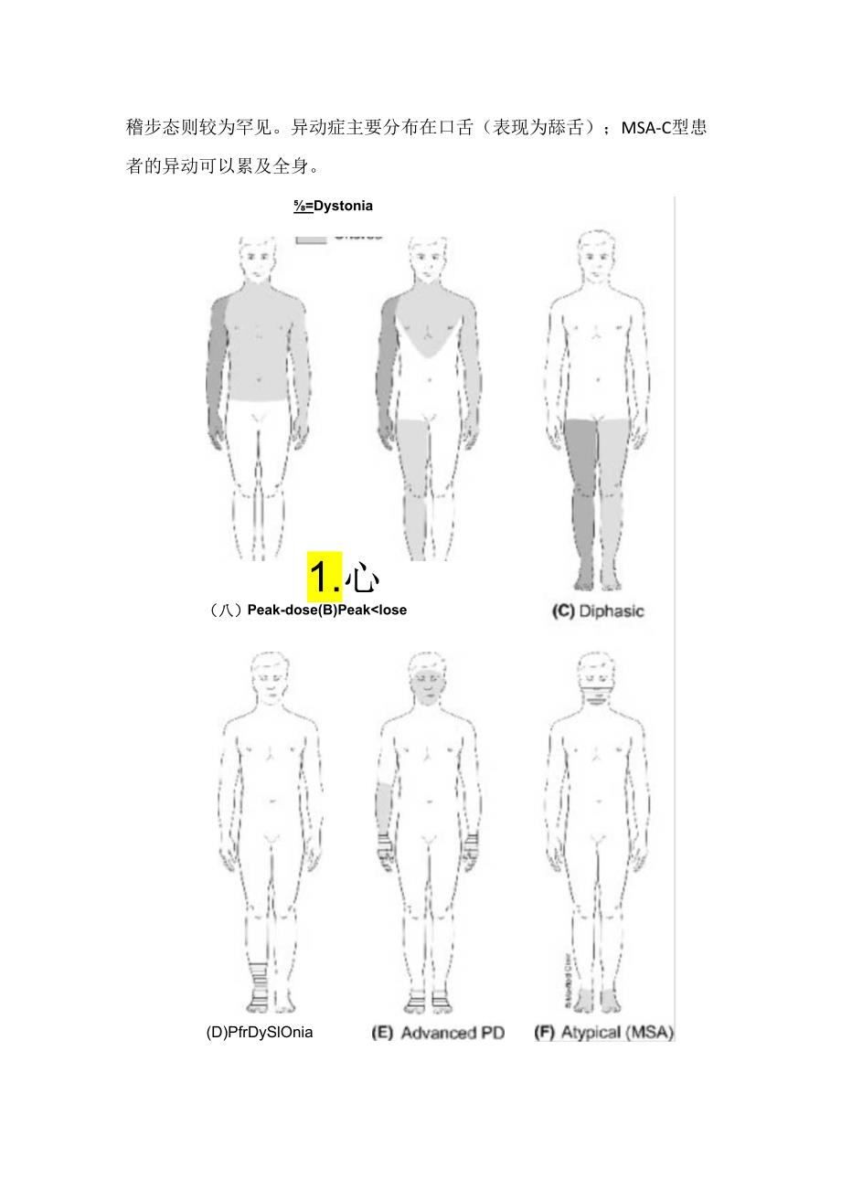 临床震颤、步态障碍、肌张力障碍等运动障碍症状学和识别.docx_第2页