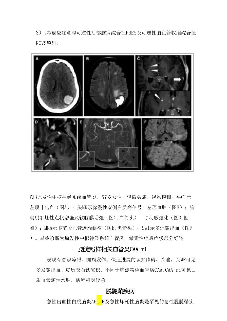 肿瘤、感染、中枢神经系统血管炎、脑血管畸形、术后远隔部位脑出血、甲醇中毒等颅内非创伤性出血少见病因及影像学特征.docx_第3页